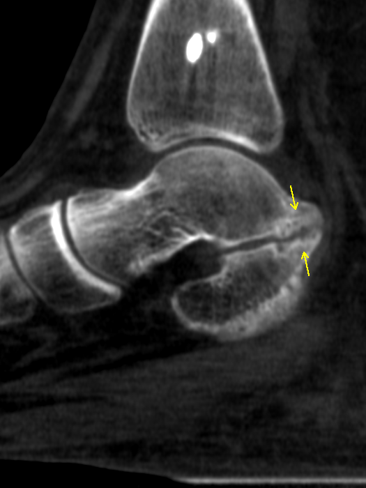 Case 1 Lateral XRay